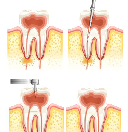 Gum Disease