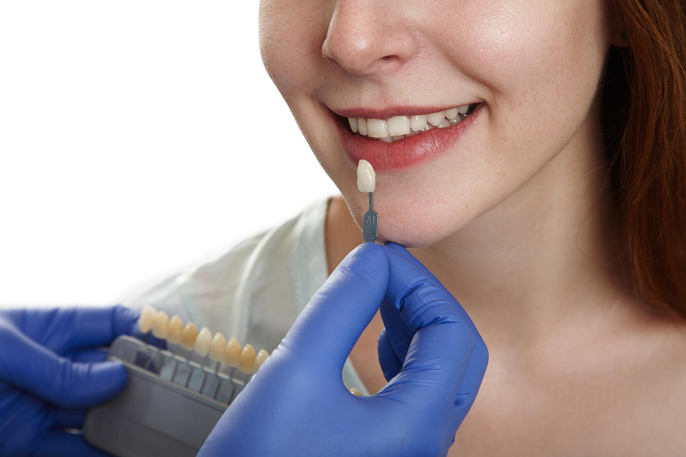 veneers