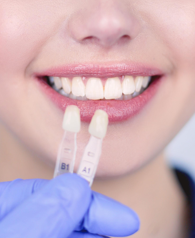 Composite Veneers