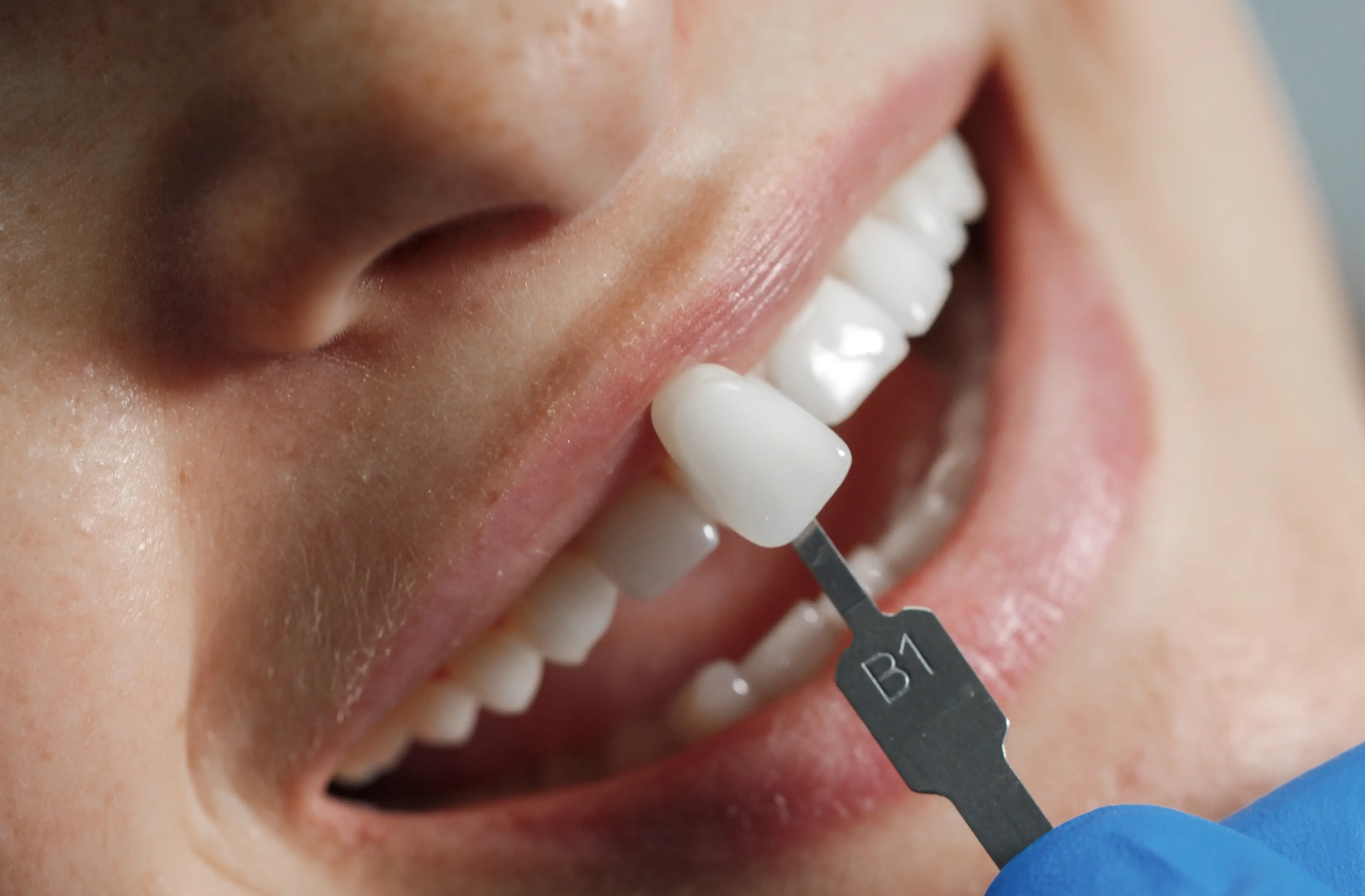 Teeth Whitening Dental Care