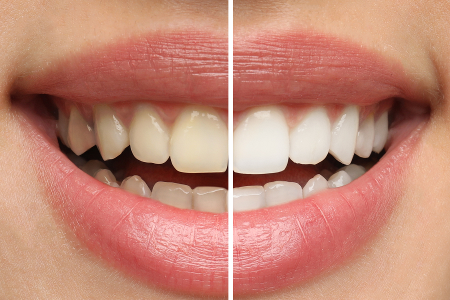 Whitening vs. Veneers: Which One Should You Choose for a Better Smile?