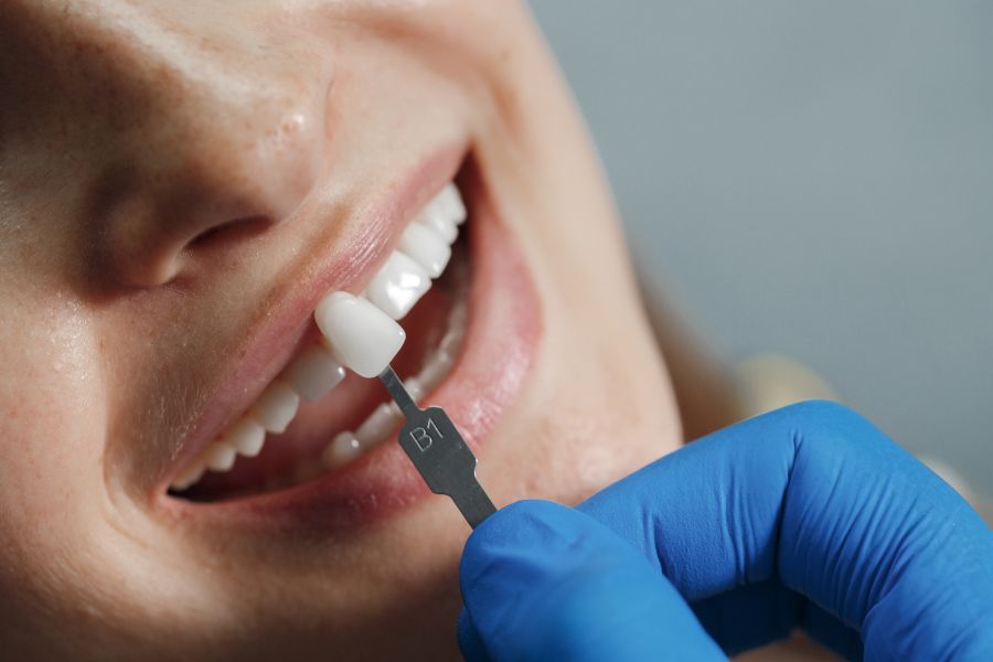 Can You Whiten Crowns, Veneers, or Fillings? Here’s What You Need to Know